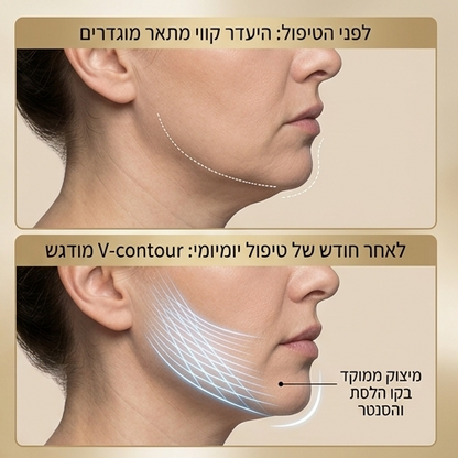 מכשיר חיטוב קו לסת V-Shape